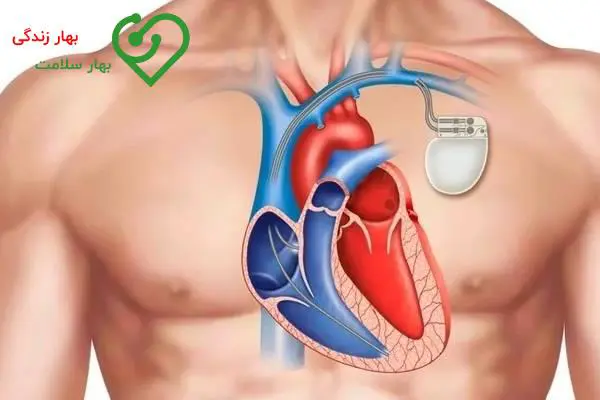 علائم و نشانههای آریتمی قلبی علائم و نشانههای آریتمی قلبی