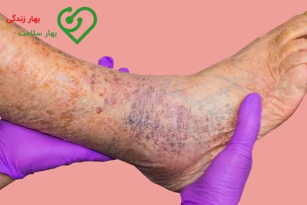    عوارض و خطرات بی توجهی به درمان واریس 