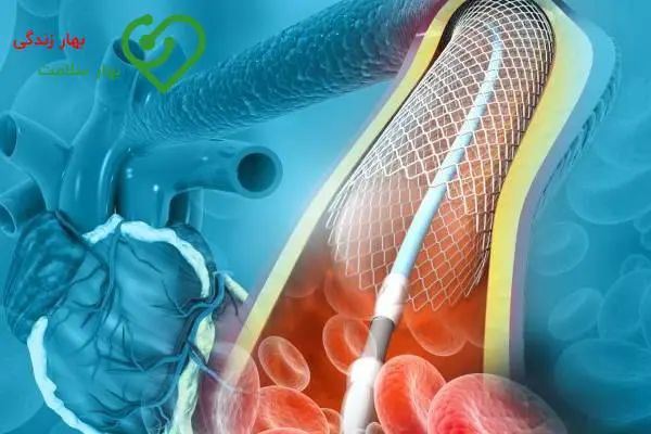 آنژیوپلاستی بعد از سکته قلبی آنژیوپلاستی بعد از سکته قلبی