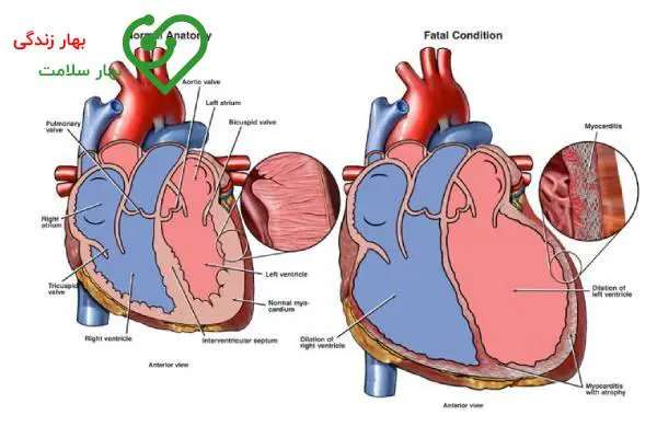 آیا روماتیسم قلبی باعث مرگ میشود؟ آیا روماتیسم قلبی باعث مرگ میشود؟