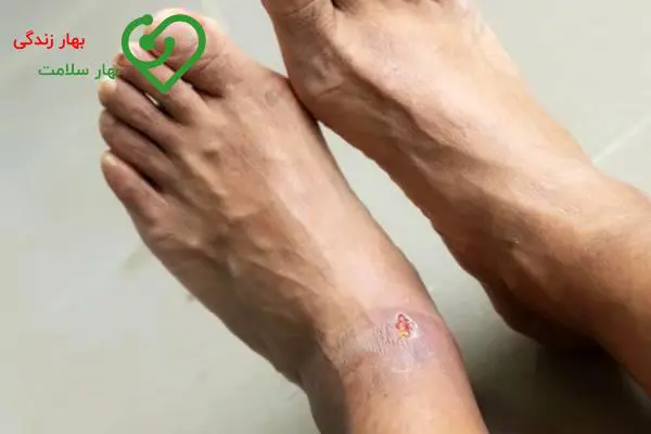 زخم پای دیابتی زخم پای دیابتی
