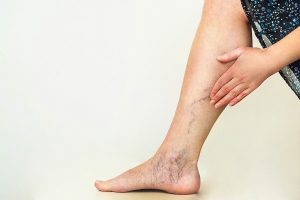 برای درمان واریس چه بخوریم؟