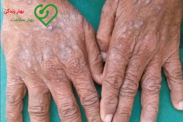 واکنش آلرژیک والزارتان واکنش آلرژیک والزارتان