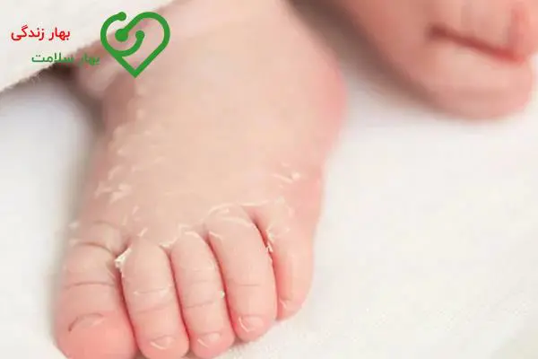چطور از بروز علائم سوختگی پا در نوزادان و کودکان جلوگیری کنیم؟ چطور از بروز علائم سوختگی پا در نوزادان و کودکان جلوگیری کنیم؟