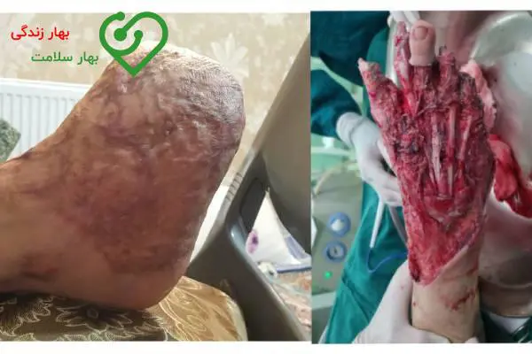 قبل و بعد درمان زخم در کلینیک بهار زندگی قبل و بعد درمان زخم در کلینیک بهار زندگی