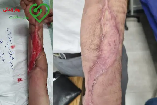 قبل و بعد درمان زخم در کلینیک بهار زندگی قبل و بعد درمان زخم در کلینیک بهار زندگی