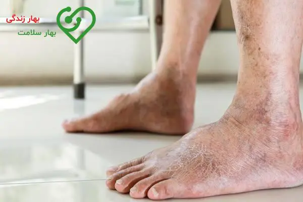 آیا آب شور رگ های واریسی را درمان می کند؟ آیا آب شور رگ های واریسی را درمان می کند؟