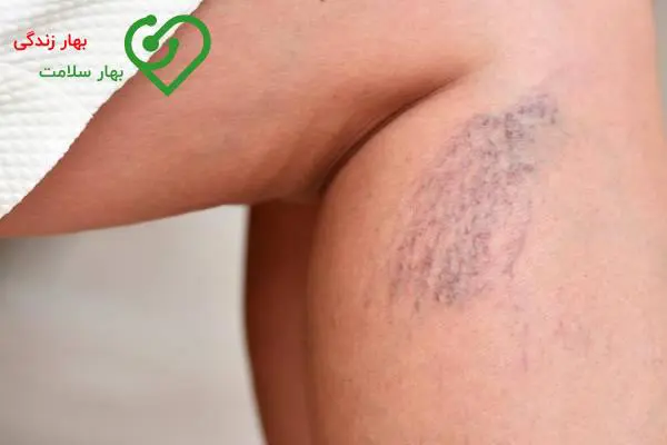غلظت خون چیست و چه علائمی دارد؟ غلظت خون چیست و چه علائمی دارد؟