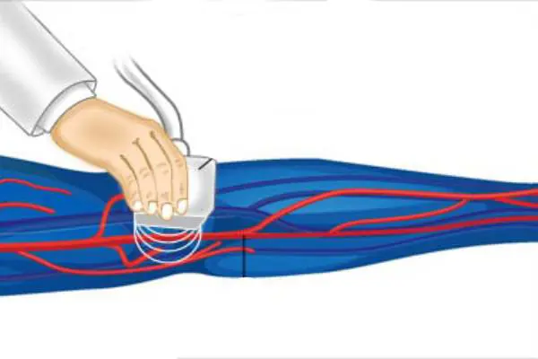 Sonography of leg varicose veins Sonography of leg varicose veins